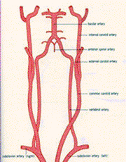 Global Ischemia