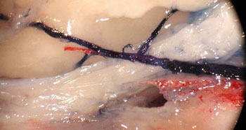 Subarachnoid hemorrhage